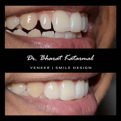 Slider image (1) Dr. Bharat Katarmal Dental and Implant Clinic